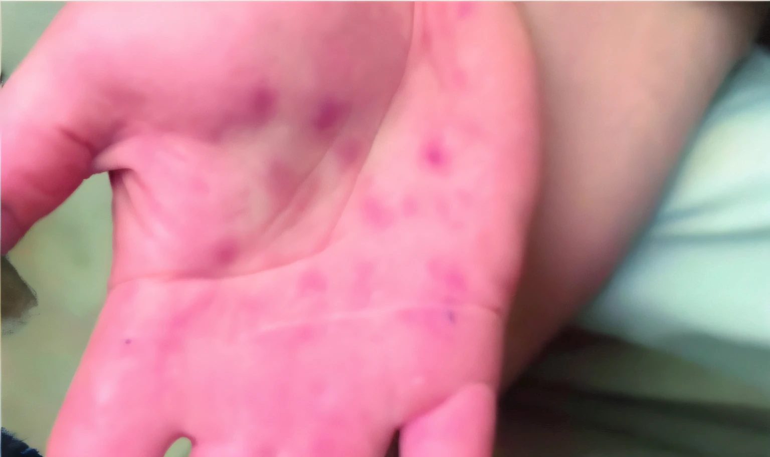 Someone is holding a pink hand with a bunch of stains on it, oozing pustules, Espinhas, tripofobia acne face, Pustules, pele manchada e acidentada, ictiose, picos no corpo, pele borbulhante, pele da vida real, sujeira - pele manchada, Feridas, Solavancos, Verrugas, pele gooey