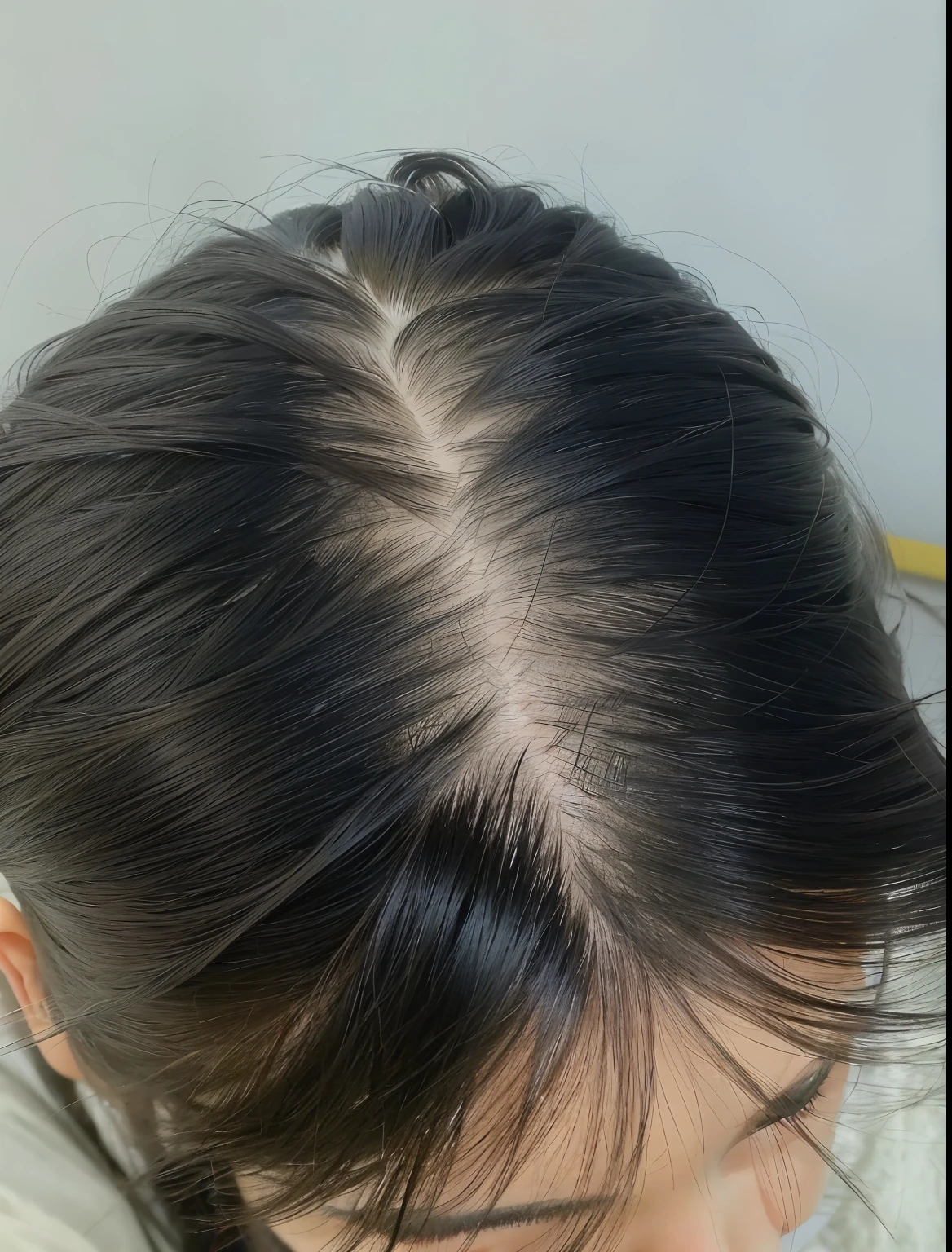 一名头上进行Thinning hair的妇女头顶特写, growth on head, Bald, Thinning hair, buzzed hair on temple, full head of hair, Partially bald, Receding hairline, parted hair, 30-year-old woman, 3 0 years old female, Dragon scales across the hairline, oily hair, Forehead exposed