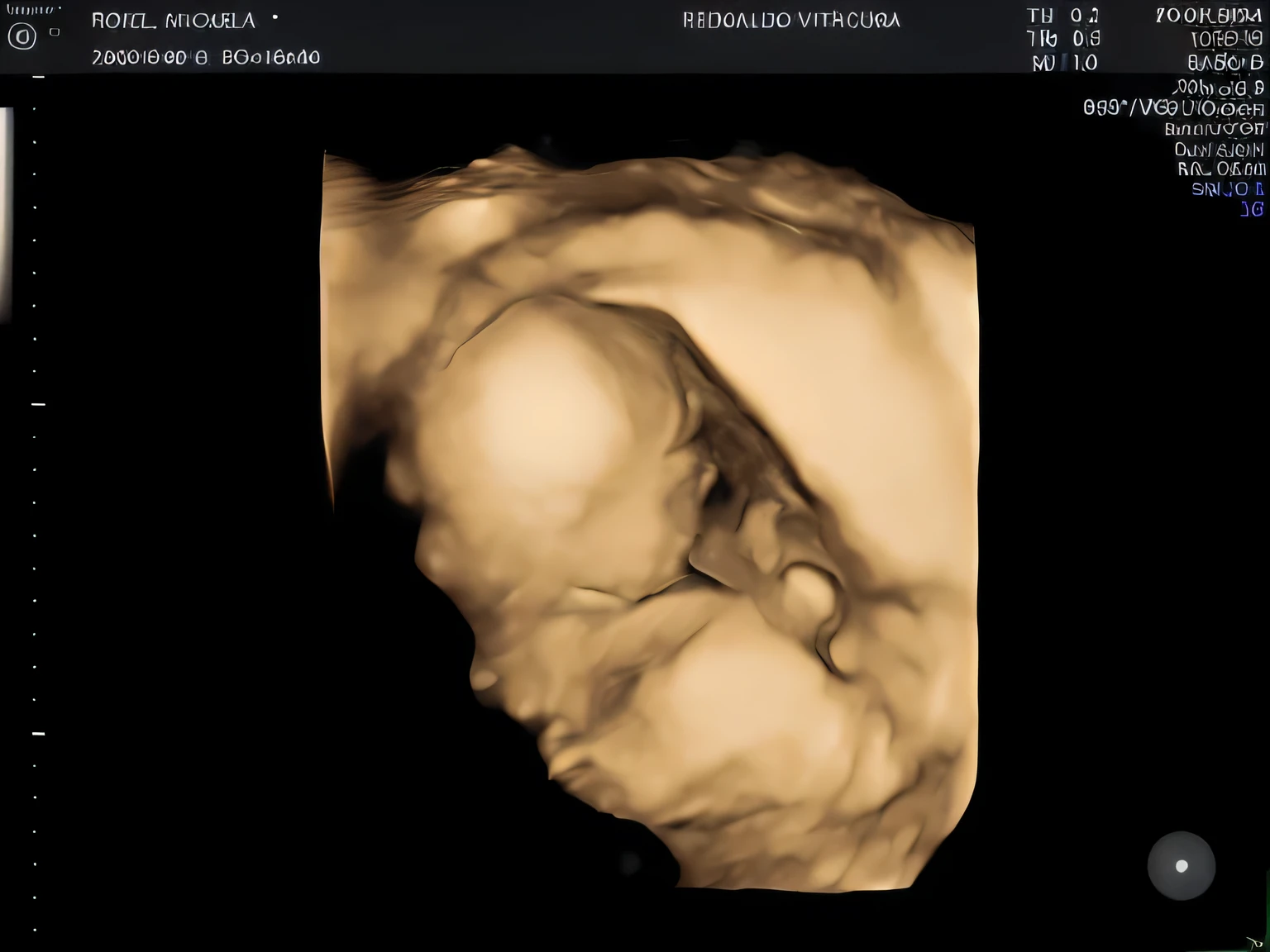 Enhance this 4D ultrasound image of a feto. Arafed image of a baby'ace., feto, high resolution scan, Very chromatic aberration., extremely escaneo de alta calidad, Hyper-realistic simulation, escaneo de alta calidad, Mapeo de relieve, Realismo 3D de alta calidad, symmetry! human feto, Textura de carne realista, Artefacto JPEG pesado borroso, Mapeo de relieves altamente realista, high resolution scan. A close-up image of a head with an image of a 17 weeks feto, high resolution scan, high resolution scan, Escaneo 4K, Escaneo 4K, Escaneo HD, feto, Cerrar - IP shot, Tapa de pantalla, Imagenes medicas, Imagen muy coherente, Detailed analysis, la captura de pantalla, extremely escaneo de alta calidad, Escaneo 8K, Escaneo 8K, Detailed la captura de pantalla. cara de perfil. Ojos cerrados