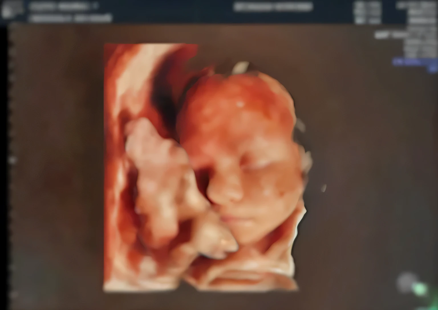 Enhance this 4D ultrasound image of a 22 weeks fetus. Arafed image of a baby's face, fetus, high-resolution scan, Very chromatic aberration, extremely high-quality scan, Hyper-realistic simulation, high-quality scan, Bump mapping, High-quality 3D realism, simetry! human fetus, Realistic flesh texture, Heavy JPEG artifact blurred, Highly realistic bump mapping, high-resolution scan. A close-up image of a head with an image of a 22 weeks fetus, high-resolution scan, high-resolution scan, Escaneo 4K, Escaneo 4K, Escaneo HD, fetus, Cerrar - IP shot, Tapa de pantalla, Medical imaging, Highly coherent image, Detailed analysis, screen capture, extremely high-quality scan, 8K scan, 8K scan, Detailed screen capture. face in profile. eyes closed