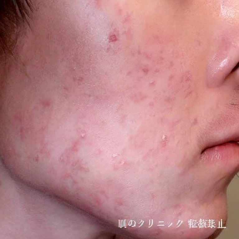 Acne-prone skin