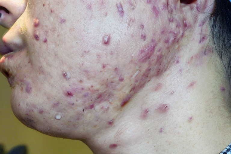 A close-up view of a person's face showing acne or pimples on the cheeks and skin irritation or redness.