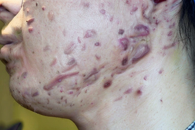 A close-up view of a person's face showing acne or pimples on the cheeks and skin irritation or redness.