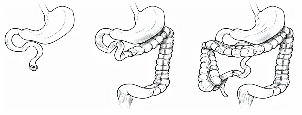 Short bowel syndrome, line drawing, ultra HD, 4K