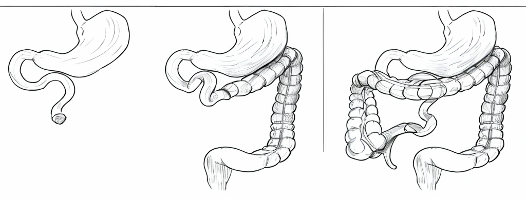 Short bowel syndrome, line drawing, ultra HD, 4K