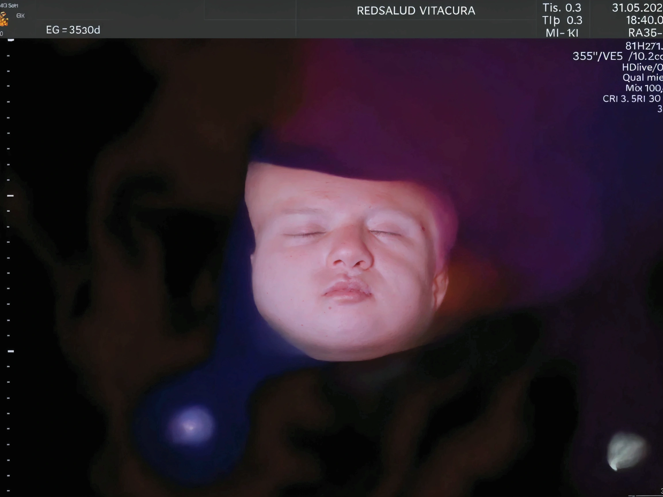 Enhance this 4D ultrasound image of a 34 weeks fetus. Arafed image of a baby's face, fetus, high-resolution scan, Very chromatic aberration, extremely high-quality scan, Hyper-realistic simulation, high-quality scan, Bump mapping, High-quality 3D realism, simetry! human fetus, Realistic flesh texture, Heavy JPEG artifact blurred, Highly realistic bump mapping, high-resolution scan. A close-up image of a head with an image of a 34 weeks fetus, high-resolution scan, high-resolution scan, Escaneo 4K, Escaneo 4K, Escaneo HD, fetus, Cerrar - IP shot, Tapa de pantalla, Medical imaging, Highly coherent image, Detailed analysis, screen capture, extremely high-quality scan, 8K scan, 8K scan, Detailed screen capture. face in profile. eyes closed