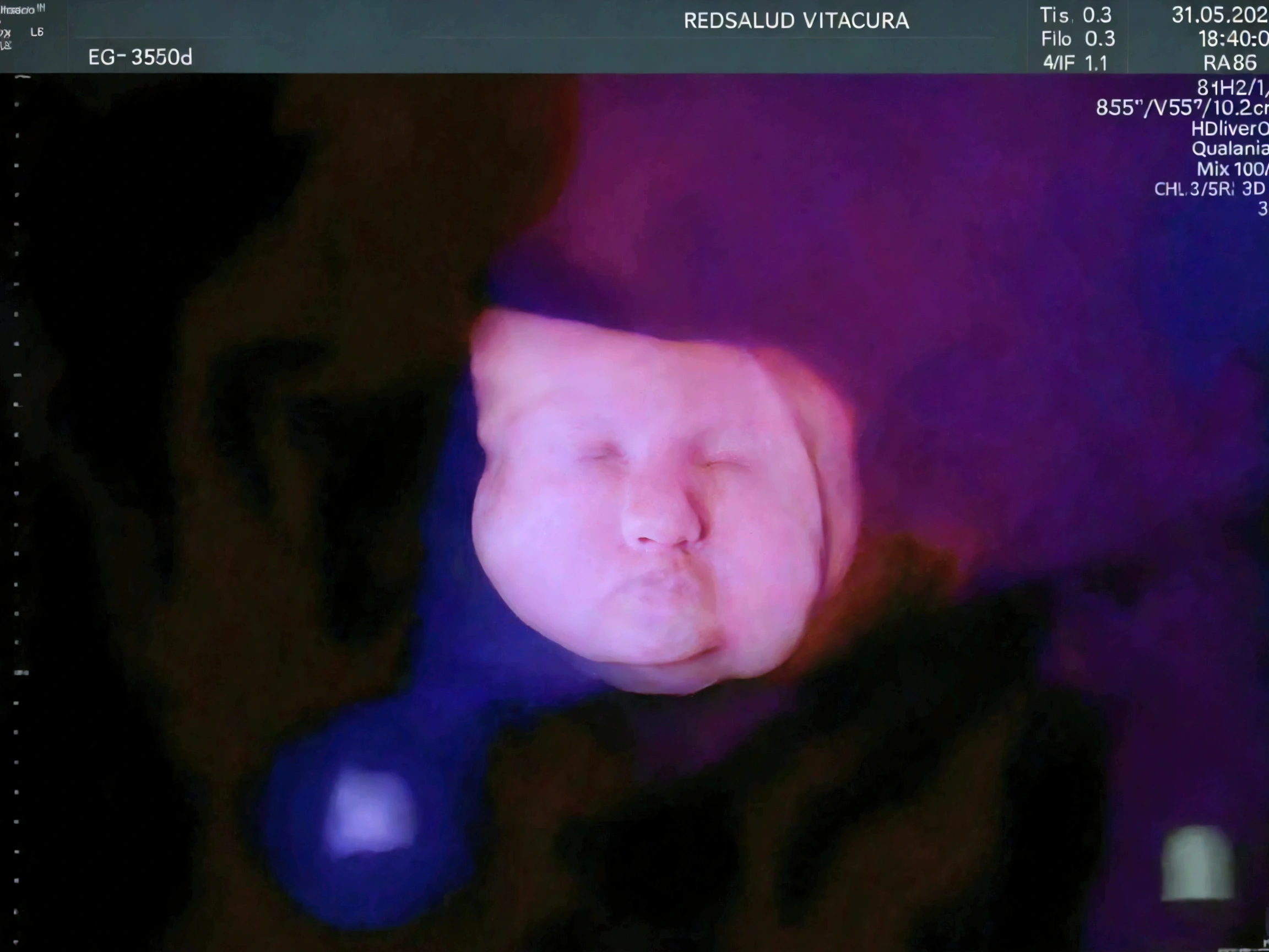 Enhance this 4D ultrasound image of a 34 weeks fetus. Arafed image of a baby's face, fetus, high-resolution scan, Very chromatic aberration, extremely high-quality scan, Hyper-realistic simulation, high-quality scan, Bump mapping, High-quality 3D realism, simetry! human fetus, Realistic flesh texture, Heavy JPEG artifact blurred, Highly realistic bump mapping, high-resolution scan. A close-up image of a head with an image of a 34 weeks fetus, high-resolution scan, high-resolution scan, Escaneo 4K, Escaneo 4K, Escaneo HD, fetus, Cerrar - IP shot, Tapa de pantalla, Medical imaging, Highly coherent image, Detailed analysis, screen capture, extremely high-quality scan, 8K scan, 8K scan, Detailed screen capture. face in profile. eyes closed