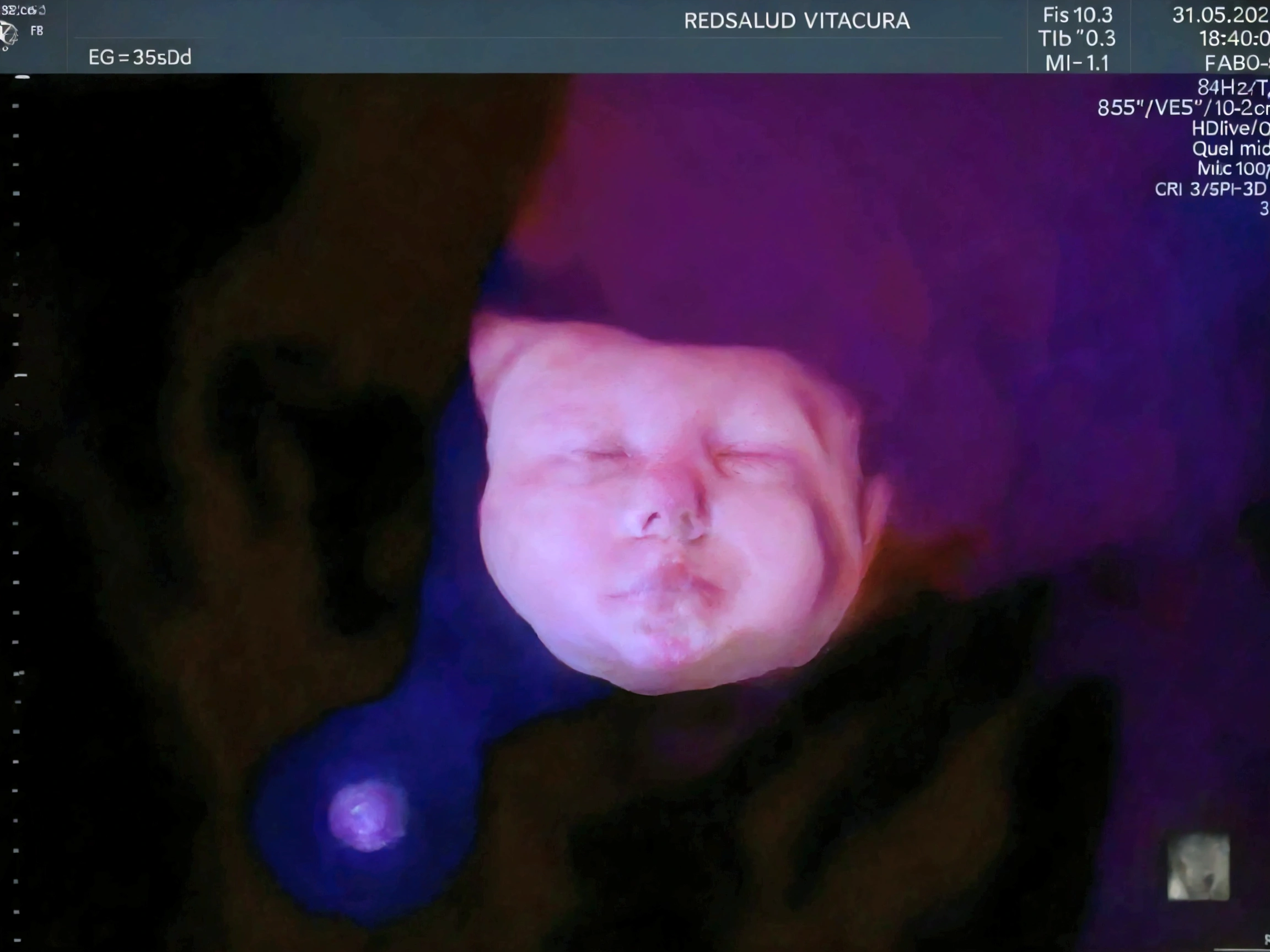 Enhance this 4D ultrasound image of a 34 weeks fetus. Arafed image of a baby's face, fetus, high-resolution scan, Very chromatic aberration, extremely high-quality scan, Hyper-realistic simulation, high-quality scan, Bump mapping, High-quality 3D realism, simetry! human fetus, Realistic flesh texture, Heavy JPEG artifact blurred, Highly realistic bump mapping, high-resolution scan. A close-up image of a head with an image of a 34 weeks fetus, high-resolution scan, high-resolution scan, Escaneo 4K, Escaneo 4K, Escaneo HD, fetus, Cerrar - IP shot, Tapa de pantalla, Medical imaging, Highly coherent image, Detailed analysis, screen capture, extremely high-quality scan, 8K scan, 8K scan, Detailed screen capture. face in profile. eyes closed