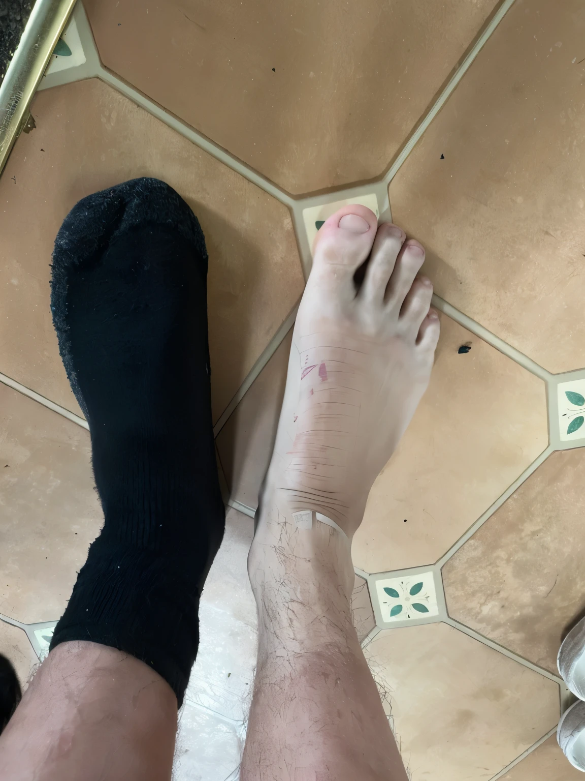 Broken and bruised foot
