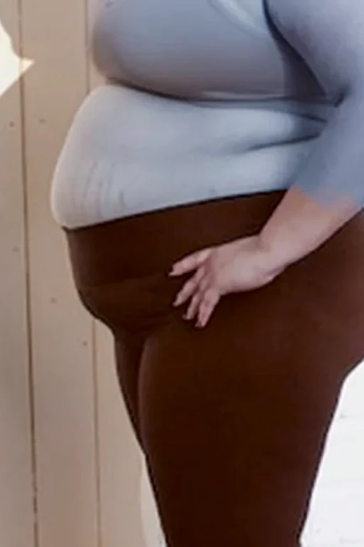 140kg extremely obese woman