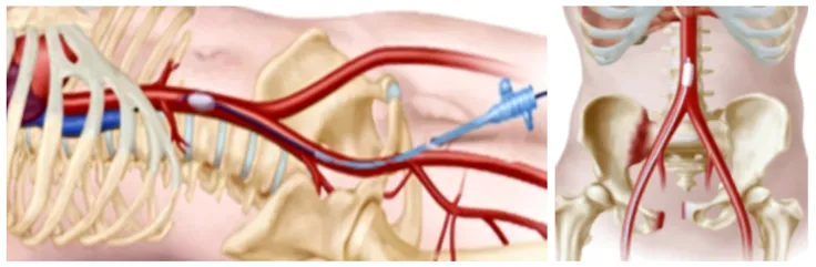 A medical illustration of a cross-section of artery, narrowed by plaque buildup, reducing blood flow. the plaque is shown in yellow.
