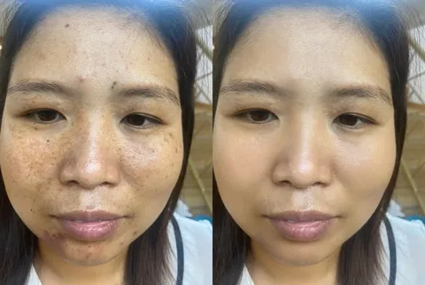 Мастер по удалению прыщей