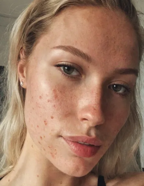 close up no make up selfie of a beauty queen, imperfect, acne:0.5, detailed upperbody, photo by ingrid baars
